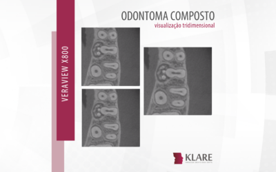 Odontoma Composto – visualização tridimensional.