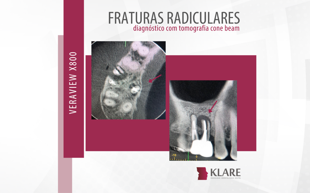 Exame radiológico identificando fraturas na arcada dentária.