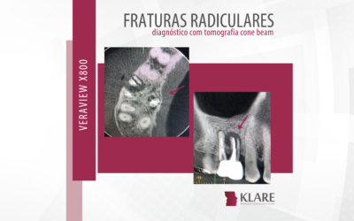 Fraturas radiculares – diagnóstico com tomografia cone beam.