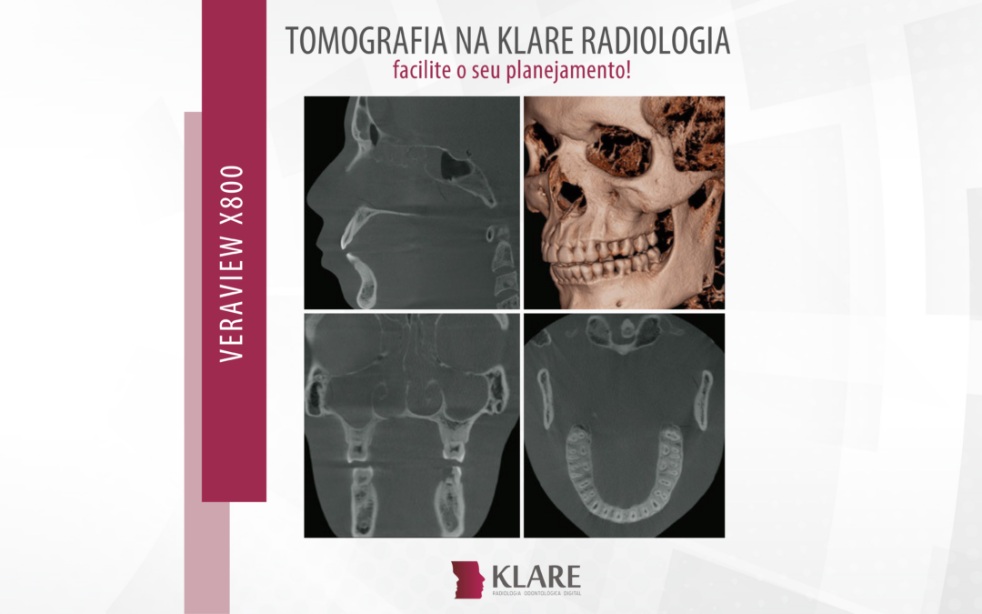 crânio e arcada dentária por tomografia