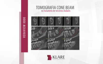 Tomografia Cone Beam – no tratamento de terceiros molares.