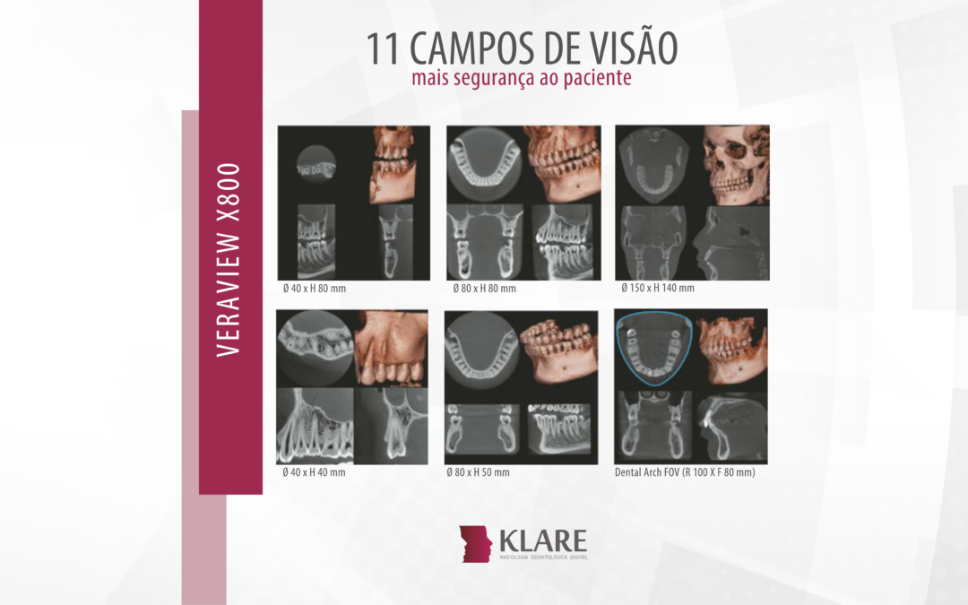 11 campos de visão – Mais segurança ao paciente.
