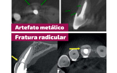 Artefato metálico X Fratura radicular