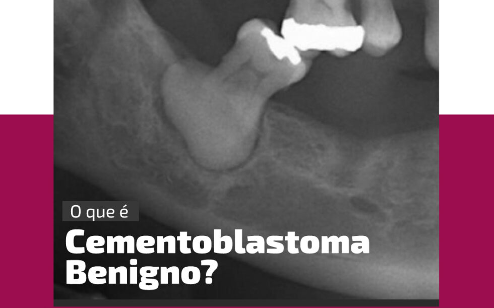 Cementoblastoma Benigno | Klare